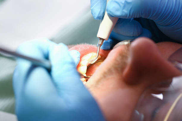Best Emergency Dental Extractions in Lansdowne, PA