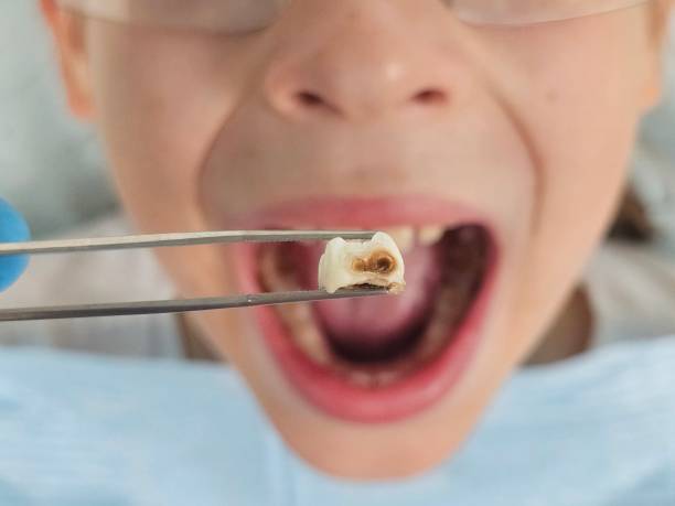 Best Broken or Cracked Tooth Emergency Dentist in Lansdowne, PA